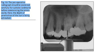 Fig. 19  The pre-operative radiograph should be examined carefully for suitable landmarks before commencing the access cavity. Here, the depth of penetration of the bur is being estimated. 