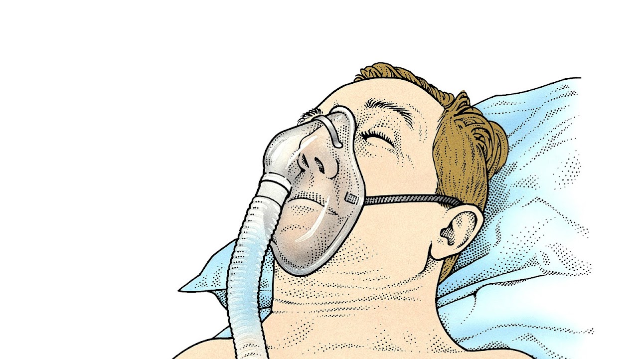 Sleep Apnea Death Rate