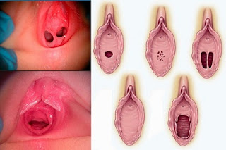 Kiểm tra màng trinh bị rách hay chưa