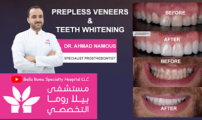Prepless Veneers &  Teeth Whitening in Bella Roma Hospital Dubai
