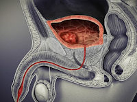  Bladder cancer symptoms and couse female