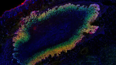 Os pesquisadores usaram o ultrassom para detectar a atividade gênica em tumores como este, que foram fotografados com uma técnica fluorescente mais antiga. A. FARHADI ET AL ., SCIENCE 365, 1469