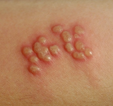 cara menyembuhkan herpes