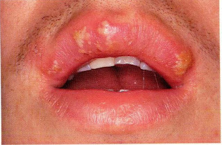 Remedy For Oral Herpes : Typical Presentation And Treatment For Herpes