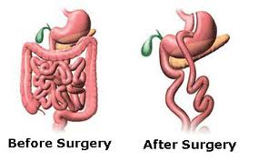 Obesity surgery: what type of surgery to lose weight?