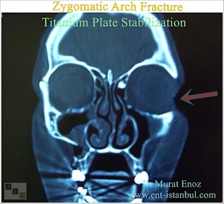 zygomatic arch anatomy, zygomatic arch fracture, titanium plate stabilization, zygomaticomaxillary complex fracture, open reduction and internal fixation, facial trauma, zygomatic fracture treatment, masseter muscle, rigid fixation, biocompatibility, comminuted fracture,
