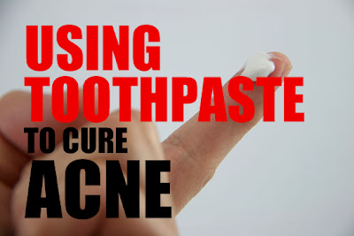 How to Get Rid of Acne Overnight with Toothpaste