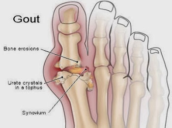 Cara Merawat Gout Acute