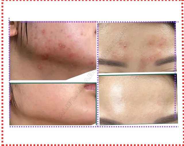 Jiaoli Skin Cream to Face Freckles Dark Spots Removal Night Cream, Original Jiaoli Cream - (20g+20g)
