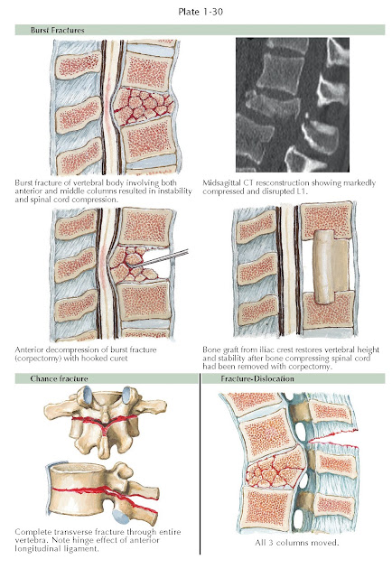 BURST, CHANCE, AND UNSTABLE FRACTURES