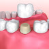 Quy trình bọc răng sứ tại nha khoa