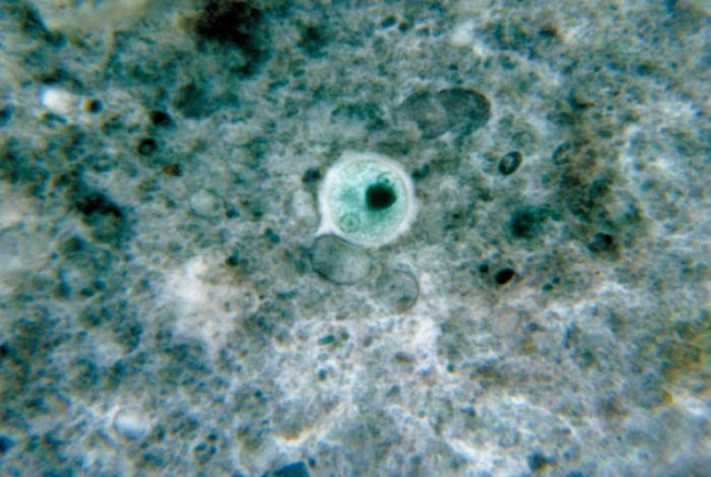 Entamoeba histolytica cyst in a micrograph, stained with chlorazol black