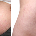 Tips Efektif, Alami Mengatasi Stretch Marks Dengan Cepat