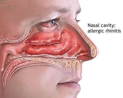 Allergic Rhinitis