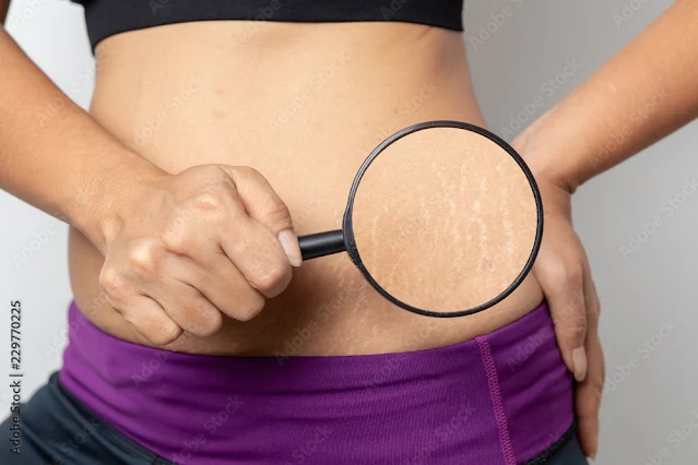How to Remove Stretch Marks : 16 Home Remedies, Treatments, Prevention Tips