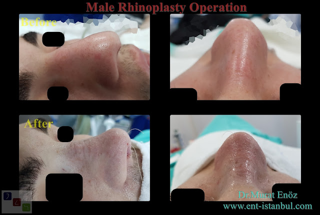 Nose Job For Men in Istanbul,Natural Male Rhinoplasty Operation,Male Nose Aesthetic Surgery in Turkey