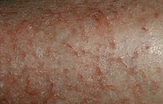 Penyakit Kulit Dermatitis Atopik, Gejala, Penyebab & Cara Mengatasi