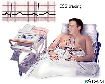 congestive heart failure  definition