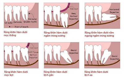 Cần lưu ý gì sau khi nhổ răng khôn?