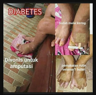 Indonesia Sehat Ads |Testimoni  Koyo One More  Diabetes