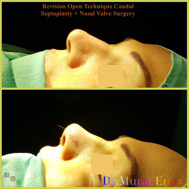 caudal septum deviation, anterior septal dislocation,caudal septal dislocation,  caudal septoplasty,Nasal valve collapse surgery,