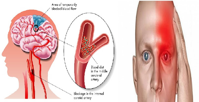 Sampung Mga Sintomas Kung Ikaw Ay Nagkaroon Na Ng Silent Stroke