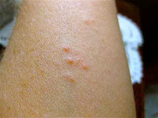 Kilohana K9s - Official Blog: What Do Bed Bug Bites Look Like?