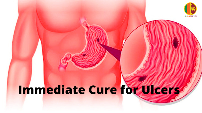 Immediate Cure for Ulcers