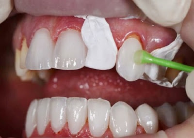 Tìm hiểu lý do bọc răng sứ bị cộm để khắc phục-2