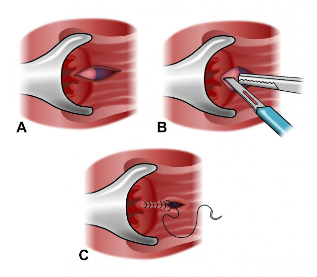 https://www.coherentmarketinsights.com/industry-reports/anal-fissure-treatment-market