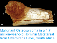 https://sciencythoughts.blogspot.com/2016/08/malignant-osteosarcoma-in-17-million.html