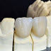 Các loại răng sứ thẩm mỹ hiện nay