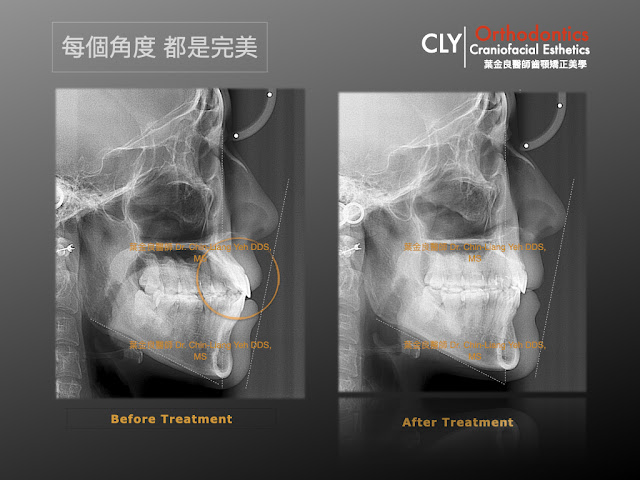 非正顎手術方法解決骨性歪斜  Skeletal Asymme