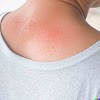 Body Rashes: Causes, Symptoms, and Treatments