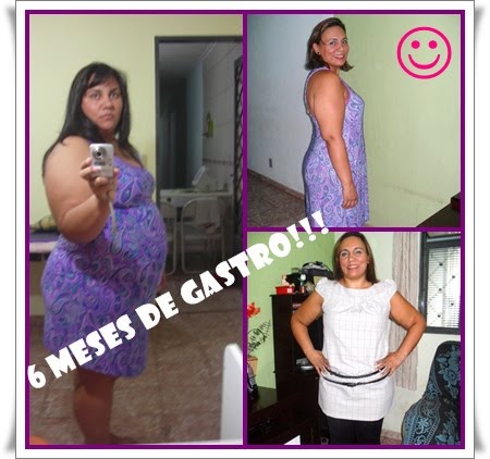 Gastroplastizada  Fabiana Rico
