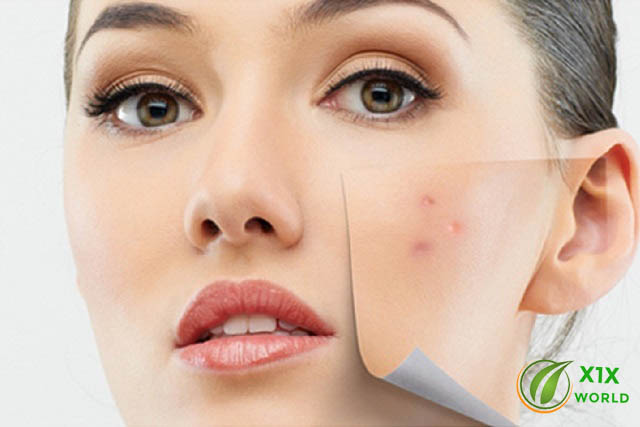 Natural Way To Control Pimples And Acnes