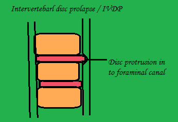 prolapsed intervertebral disc|pivd definition|pivd stages|pivd types|intervertebral disc prolapse