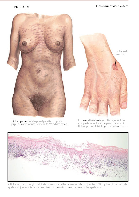 LICHENOID KERATOSIS