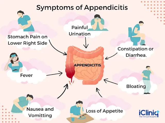 Appendicitis