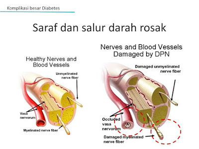 Ubat Saraf Diabetik - Rawatan m