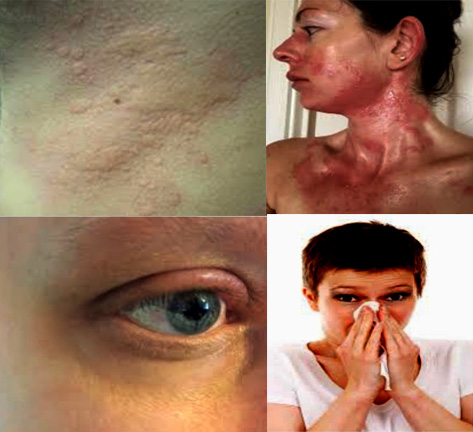 Allergies: Allergens, Symptoms, Diagnosis and Treatment.