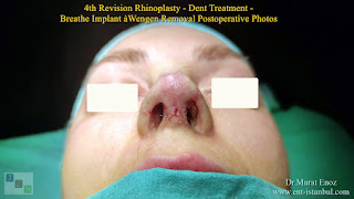 Breathe Implant à Wengen,4. revision nose job, Dent After Rhinoplasty, Complicated 4th Revision Rhinoplasty, Nasal contour irregularities, Postoperative dent issues, Revision rhinoplasty challenges, Rhinoplasty side effects, Nasal structural integrity,