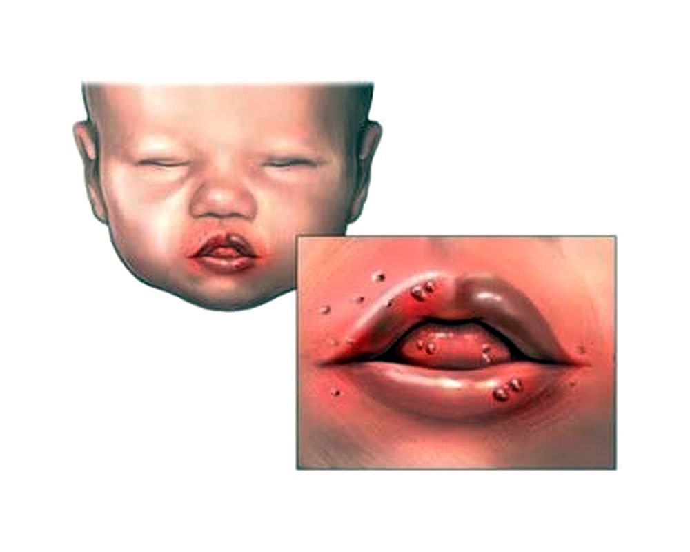 Dermatitis Perioral