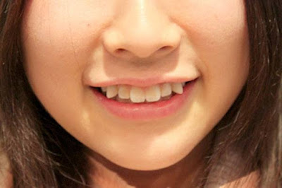 Trồng răng khểnh giả giúp nụ cười tỏa nắng hơn