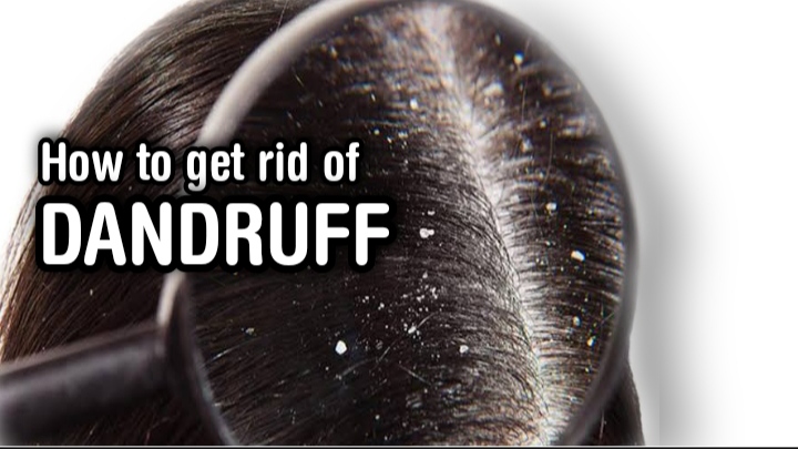 How to get rid of dandruff easily home remedies