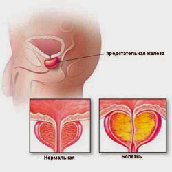 Признаки аденомы предстательной железы