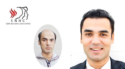 hair transplant in pakistan