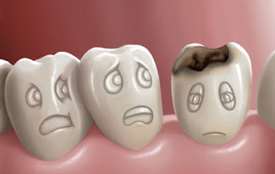 Nguyên nhân răng trám bị sâu lại