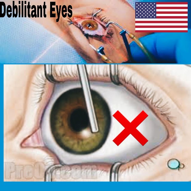 Eye operation for removing spectacles cost.