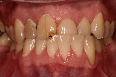 2 nhóm nguyên nhân răng bị vàng ố phổ biến nhất